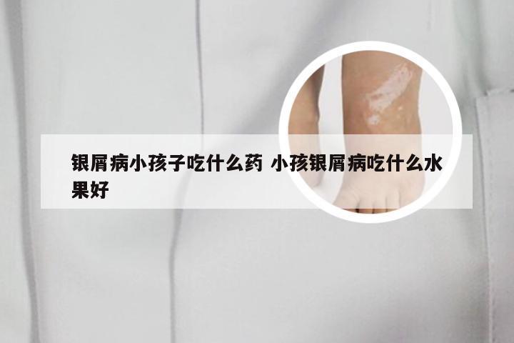银屑病小孩子吃什么药 小孩银屑病吃什么水果好