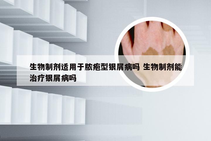 生物制剂适用于脓疱型银屑病吗 生物制剂能治疗银屑病吗