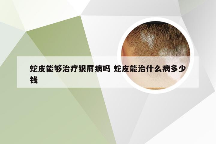 蛇皮能够治疗银屑病吗 蛇皮能治什么病多少钱