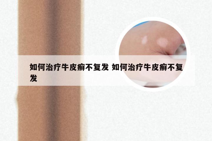 如何治疗牛皮癣不复发 如何治疗牛皮癣不复发