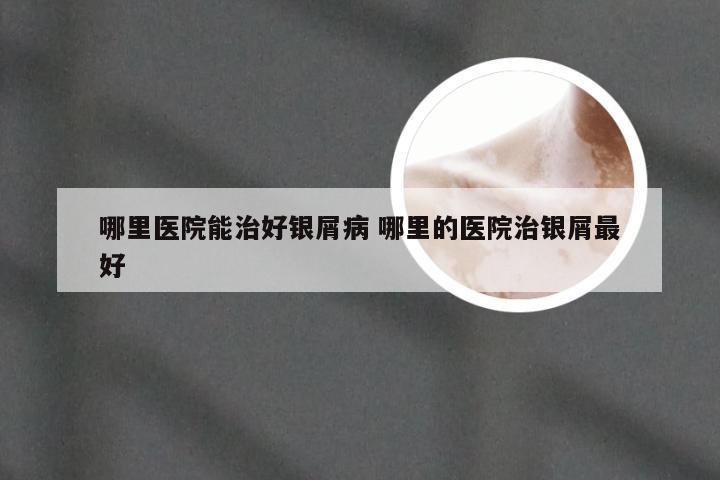 哪里医院能治好银屑病 哪里的医院治银屑最好