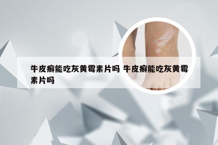 牛皮癣能吃灰黄霉素片吗 牛皮癣能吃灰黄霉素片吗