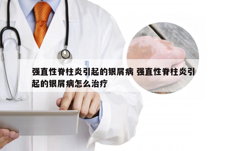 强直性脊柱炎引起的银屑病 强直性脊柱炎引起的银屑病怎么治疗