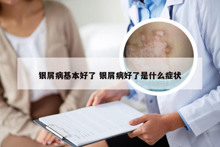 银屑病基本好了 银屑病好了是什么症状