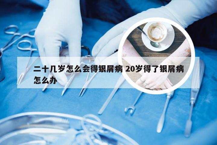 二十几岁怎么会得银屑病 20岁得了银屑病怎么办