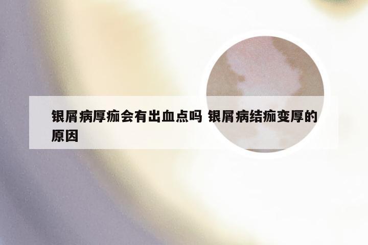 银屑病厚痂会有出血点吗 银屑病结痂变厚的原因