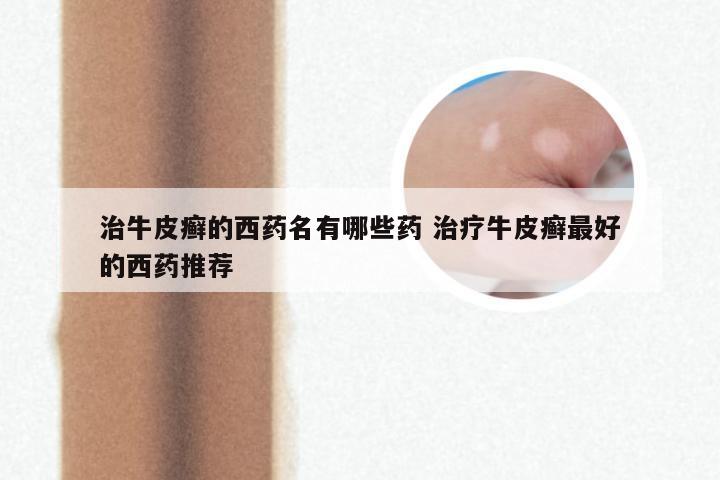 治牛皮癣的西药名有哪些药 治疗牛皮癣最好的西药推荐
