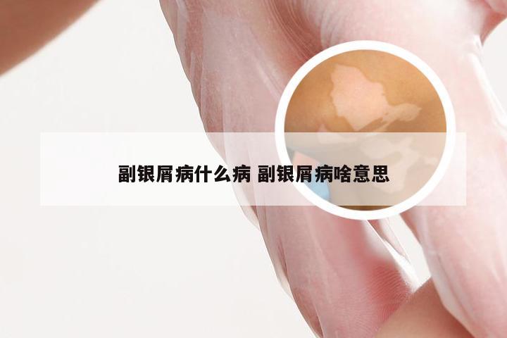 副银屑病什么病 副银屑病啥意思
