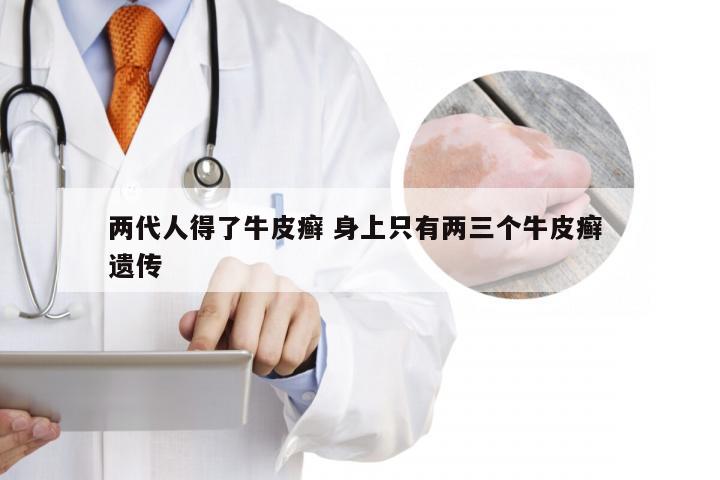 两代人得了牛皮癣 身上只有两三个牛皮癣 遗传