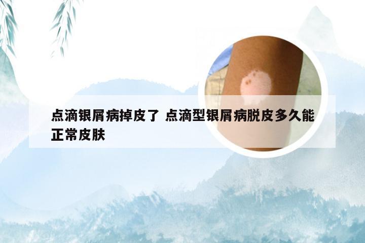 点滴银屑病掉皮了 点滴型银屑病脱皮多久能正常皮肤