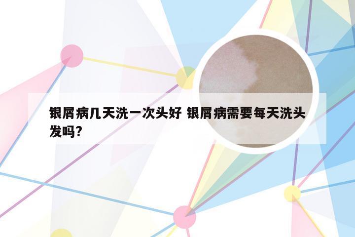 银屑病几天洗一次头好 银屑病需要每天洗头发吗?