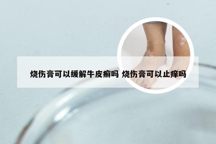 烧伤膏可以缓解牛皮癣吗 烧伤膏可以止痒吗