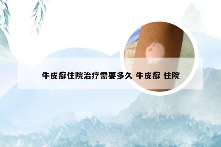 牛皮癣住院治疗需要多久 牛皮癣 住院