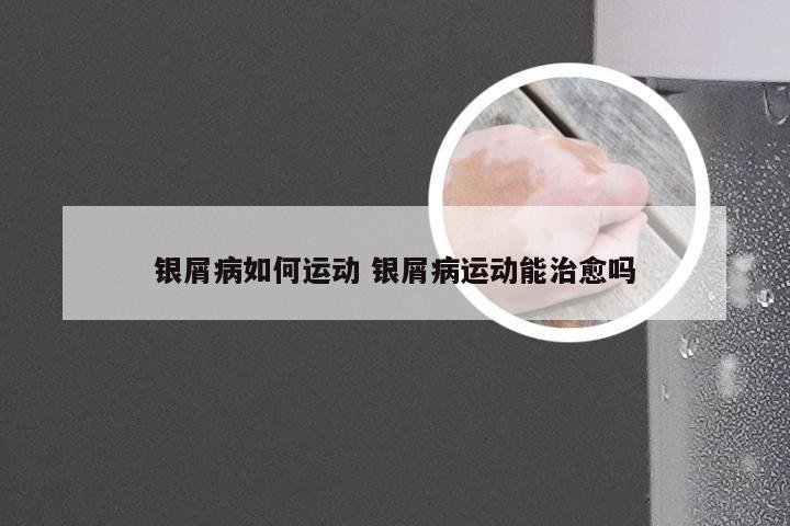 银屑病如何运动 银屑病运动能治愈吗