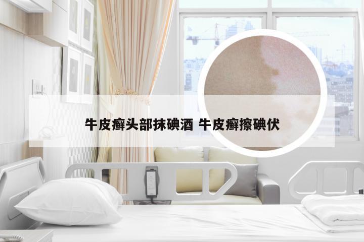 牛皮癣头部抹碘酒 牛皮癣擦碘伏