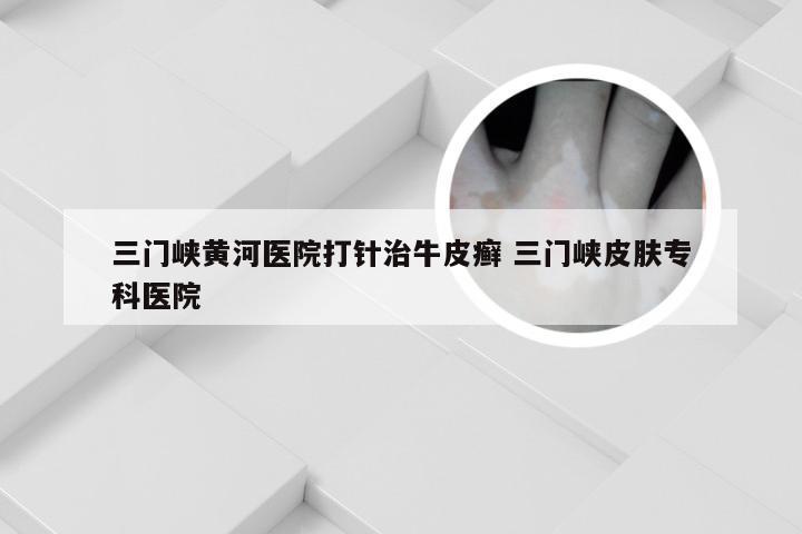 三门峡黄河医院打针治牛皮癣 三门峡皮肤专科医院