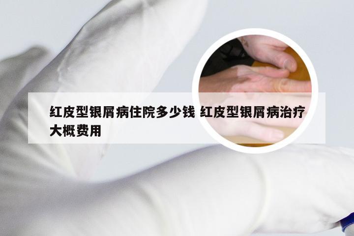 红皮型银屑病住院多少钱 红皮型银屑病治疗大概费用
