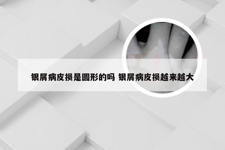 银屑病皮损是圆形的吗 银屑病皮损越来越大