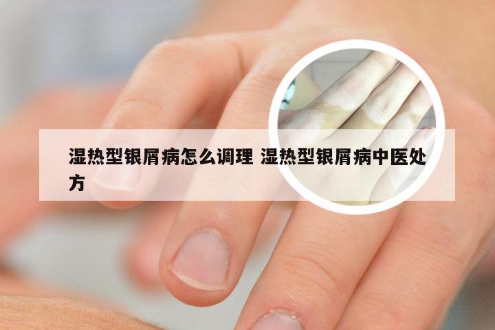 湿热型银屑病怎么调理 湿热型银屑病中医处方