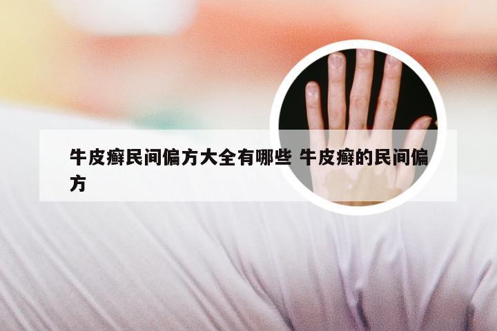 牛皮癣民间偏方大全有哪些 牛皮癣的民间偏方