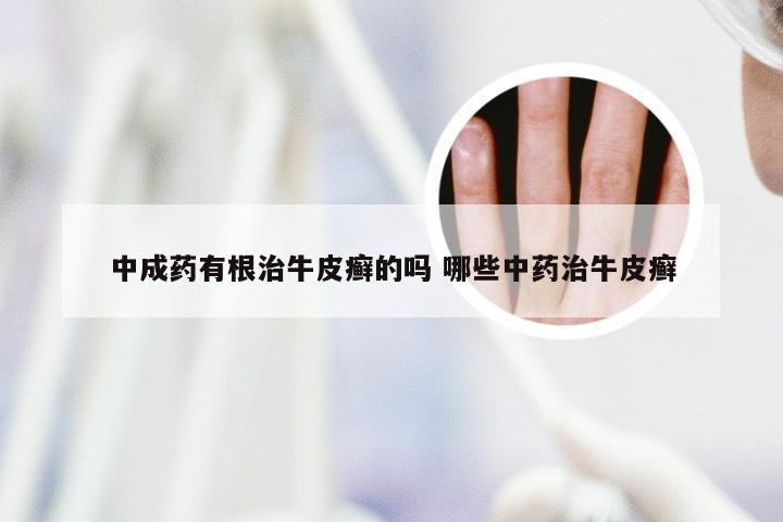 中成药有根治牛皮癣的吗 哪些中药治牛皮癣