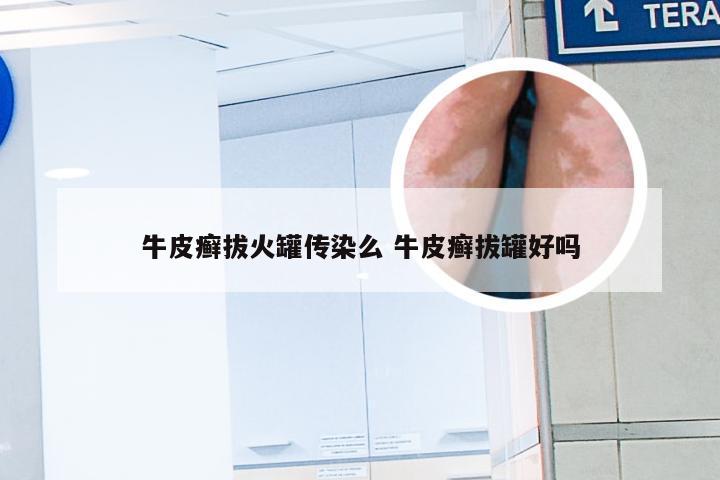 牛皮癣拔火罐传染么 牛皮癣拔罐好吗