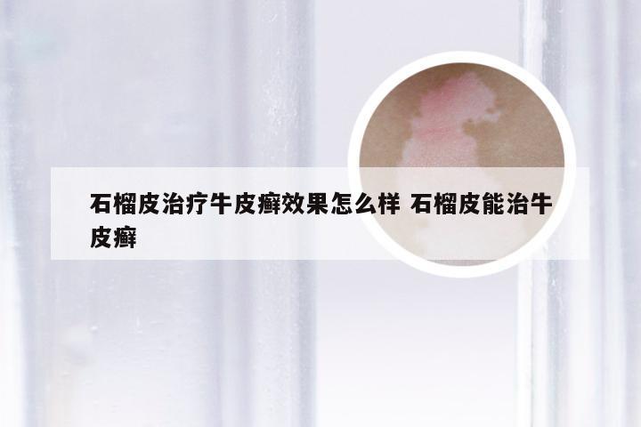 石榴皮治疗牛皮癣效果怎么样 石榴皮能治牛皮癣