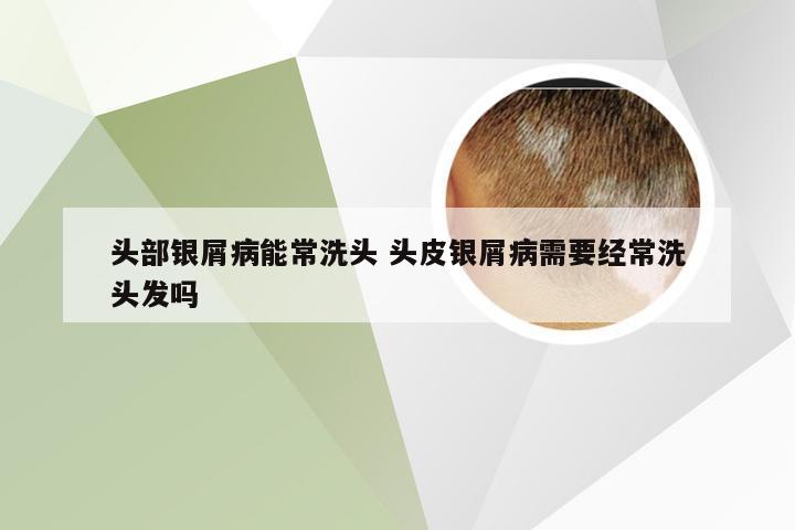 头部银屑病能常洗头 头皮银屑病需要经常洗头发吗