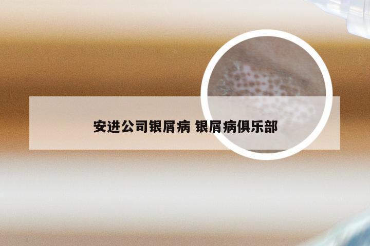 安进公司银屑病 银屑病俱乐部