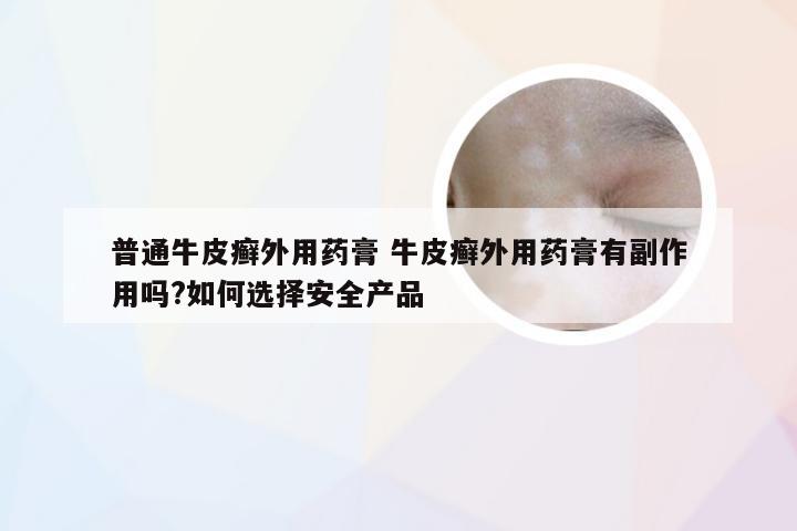 普通牛皮癣外用药膏 牛皮癣外用药膏有副作用吗?如何选择安全产品