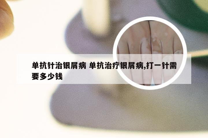 单抗针治银屑病 单抗治疗银屑病,打一针需要多少钱