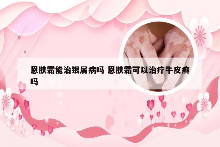 恩肤霜能治银屑病吗 恩肤霜可以治疗牛皮癣吗