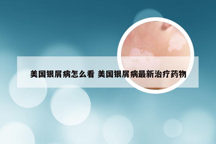 美国银屑病怎么看 美国银屑病最新治疗药物