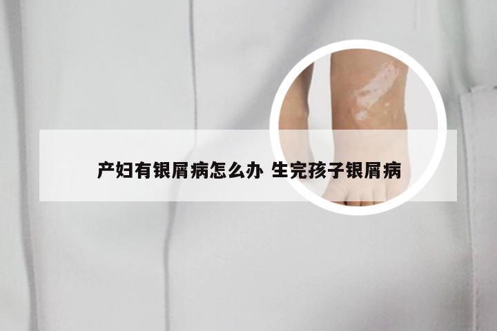 产妇有银屑病怎么办 生完孩子银屑病