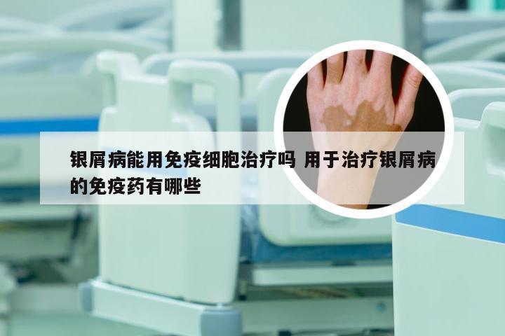 银屑病能用免疫细胞治疗吗 用于治疗银屑病的免疫药有哪些