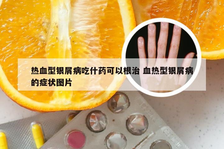 热血型银屑病吃什药可以根治 血热型银屑病的症状图片
