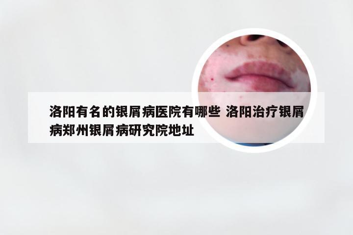 洛阳有名的银屑病医院有哪些 洛阳治疗银屑病郑州银屑病研究院地址