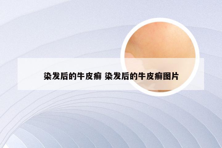 染发后的牛皮癣 染发后的牛皮癣图片