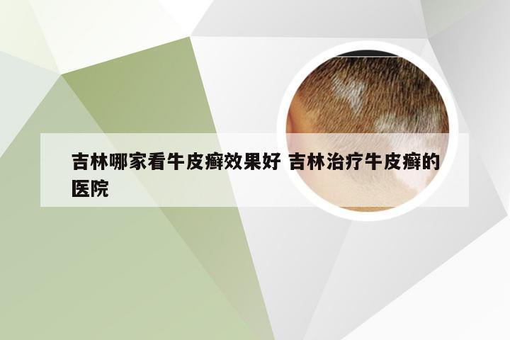 吉林哪家看牛皮癣效果好 吉林治疗牛皮癣的医院