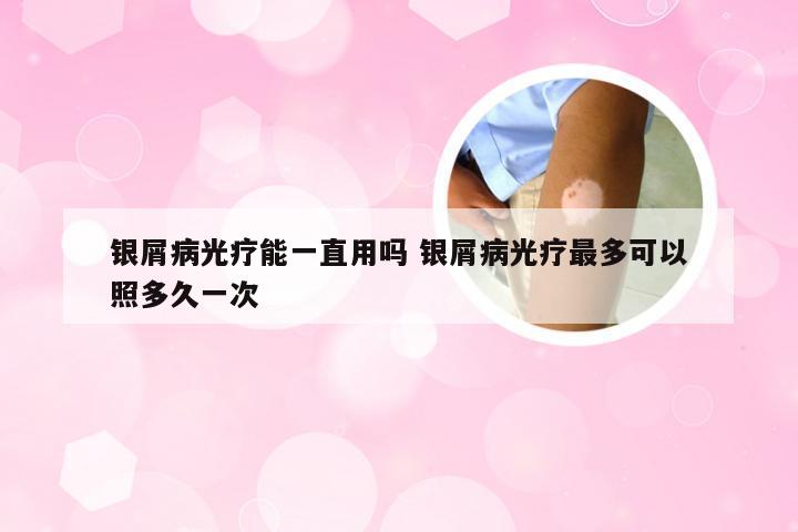 银屑病光疗能一直用吗 银屑病光疗最多可以照多久一次