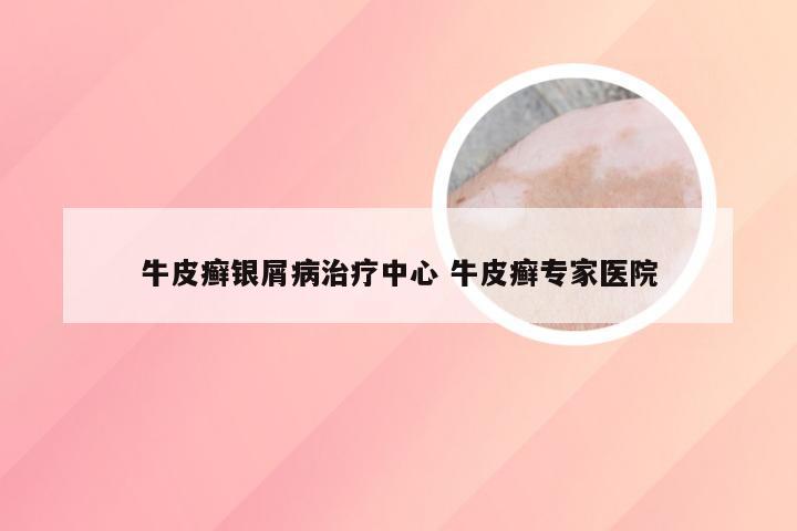 牛皮癣银屑病治疗中心 牛皮癣专家医院