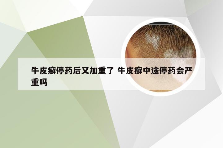 牛皮癣停药后又加重了 牛皮癣中途停药会严重吗