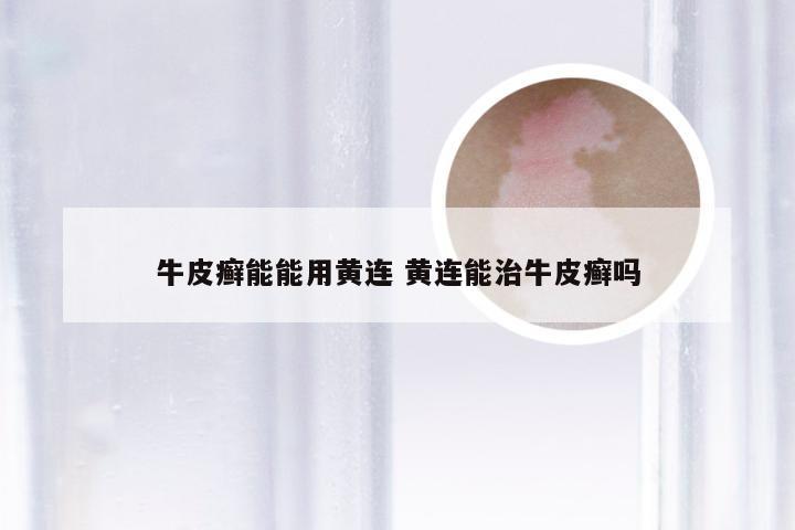 牛皮癣能能用黄连 黄连能治牛皮癣吗