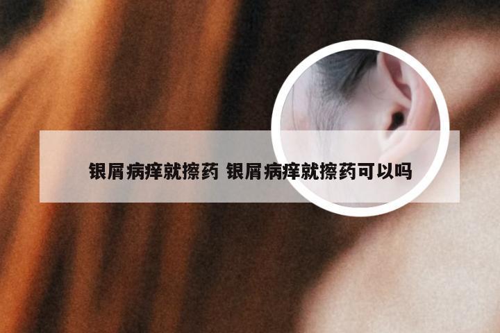 银屑病痒就擦药 银屑病痒就擦药可以吗