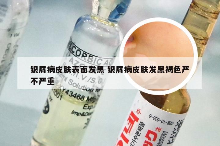银屑病皮肤表面发黑 银屑病皮肤发黑褐色严不严重