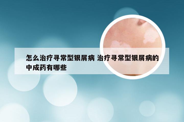 怎么治疗寻常型银屑病 治疗寻常型银屑病的中成药有哪些