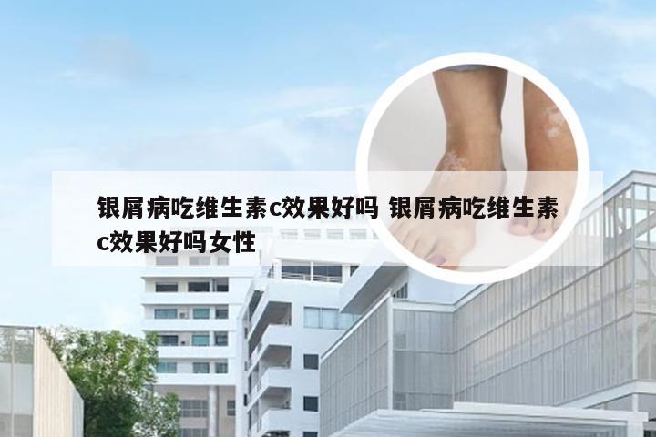 银屑病吃维生素c效果好吗 银屑病吃维生素c效果好吗女性