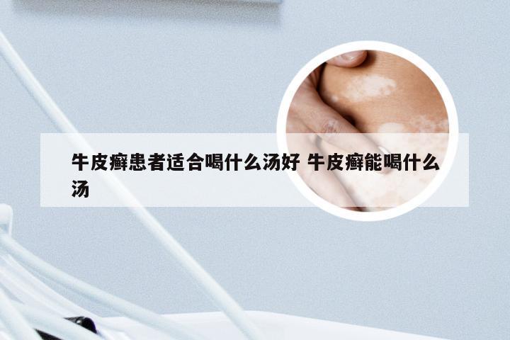 牛皮癣患者适合喝什么汤好 牛皮癣能喝什么汤