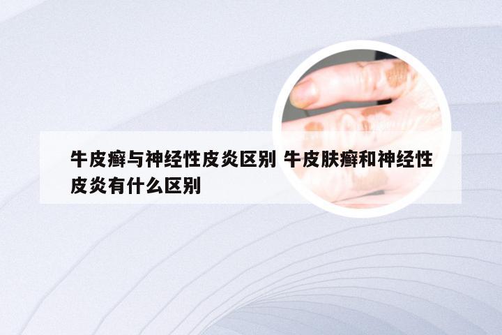 牛皮癣与神经性皮炎区别 牛皮肤癣和神经性皮炎有什么区别