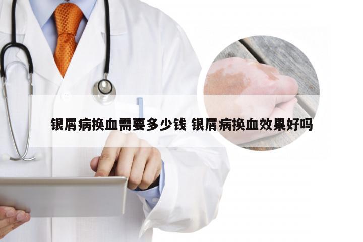 银屑病换血需要多少钱 银屑病换血效果好吗